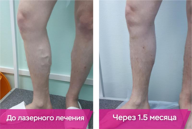Варикоз вен на ногах – симптомы, признаки, лечение, что можно и что нельзя при варикозе