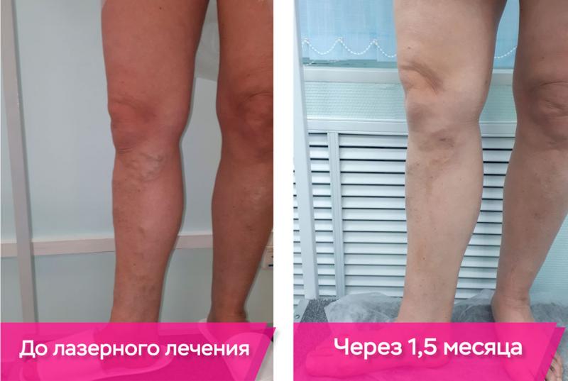 Варикозное расширения вен на ногах, цены на лечение варикоза в клинике Гемостаза в Москве