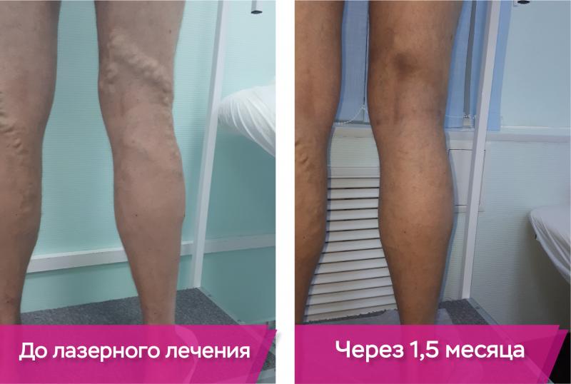 Потемнение кожных покровов на ногах или пигментация кожи
